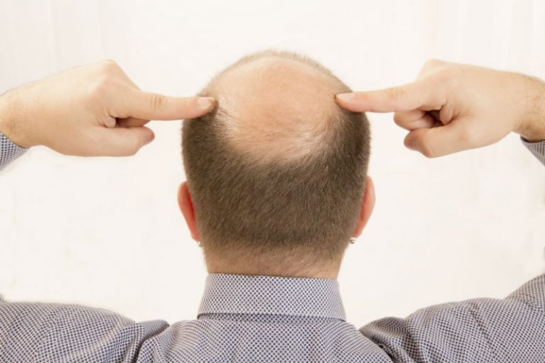 Reasons to Consider a High-Quality Hair Transplant Clinic in Pennsylvania