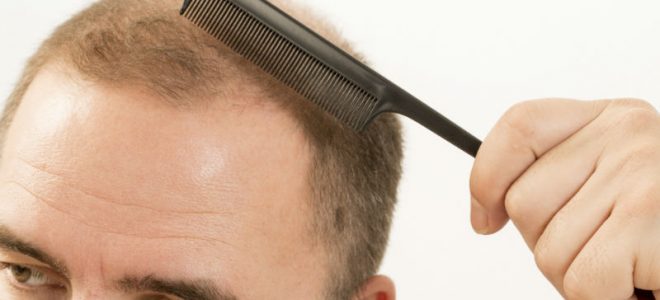 Unveiling the Advantages of FUE Procedure in Fort Lauderdale, FL