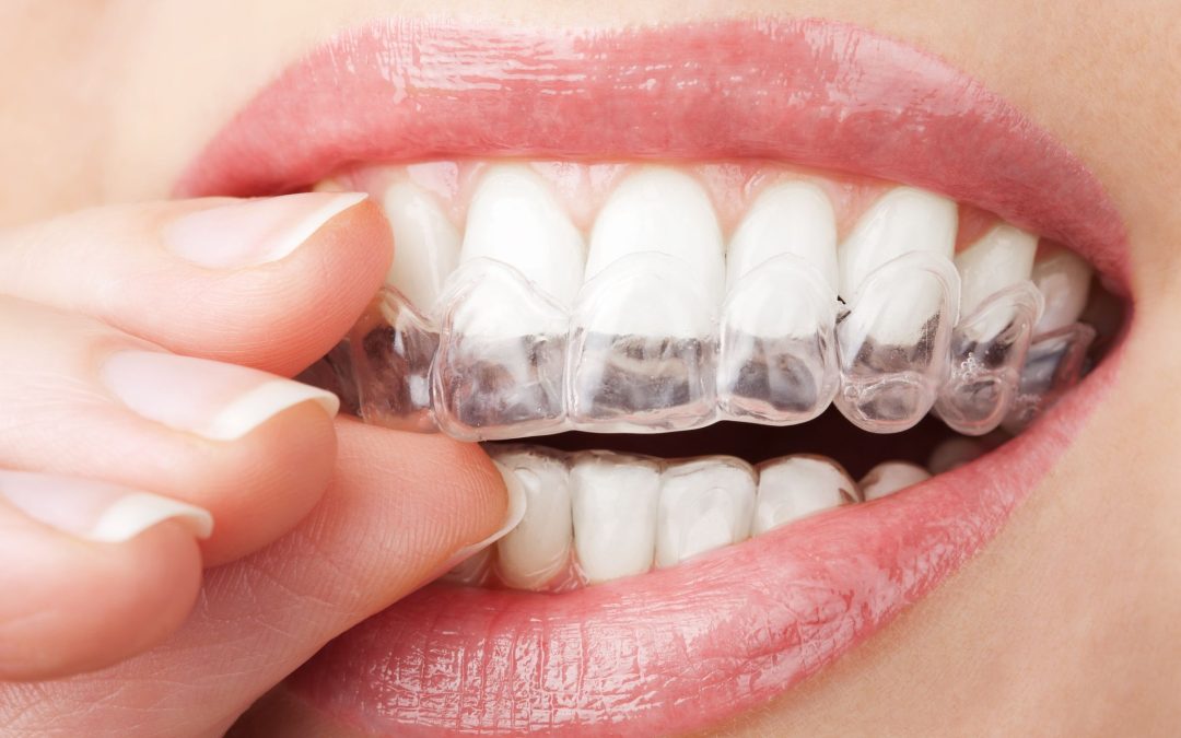 Invisalign In Medina OH: Straighten Your Teeth Comfortably And Discreetly
