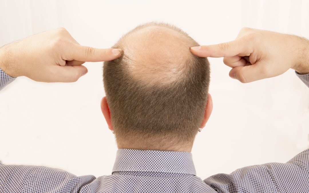Regain Confidence with Hair Restoration Troy MI for Fuller, Healthier Looking Hair