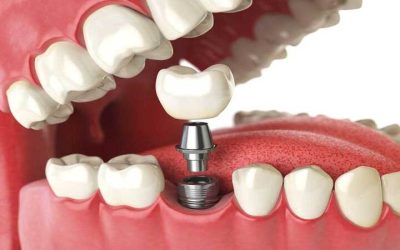 Restore Your Confidence with Advanced Care at the Dental Implant Institute Pennsylvania