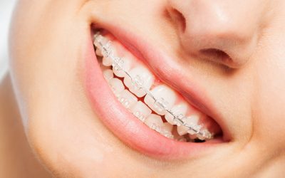 Real Life Transformations Achieved with Invisalign Braces Eldora Solutions
